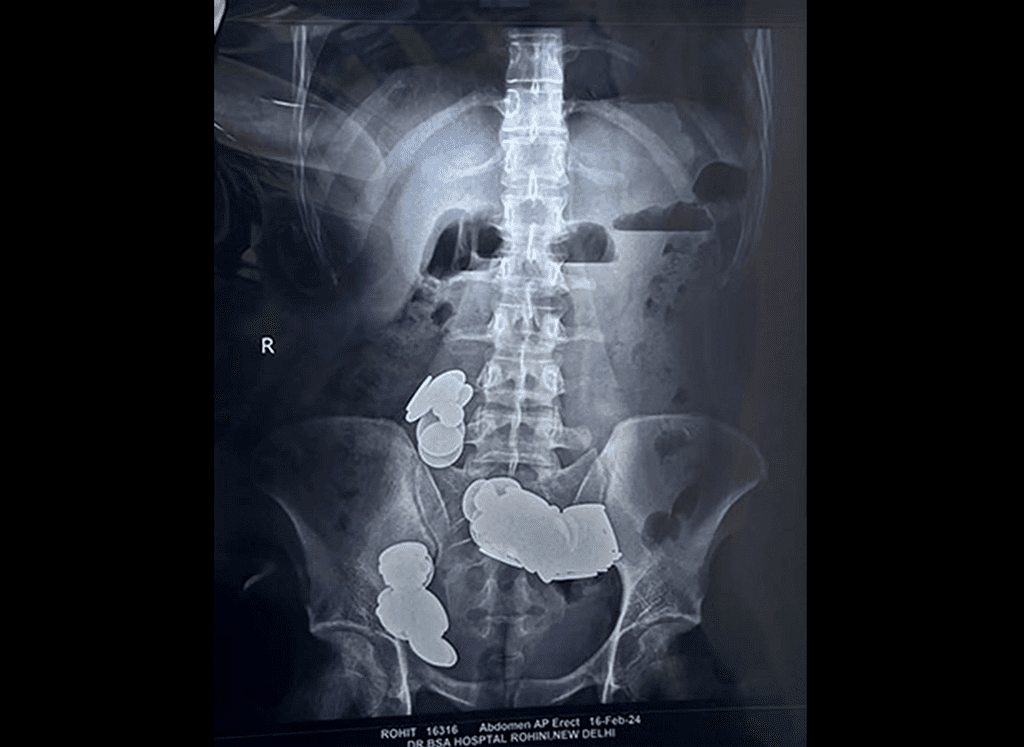 Os médicos retiraram moedas de uma, duas e cinco rúpias, além dos imãs de diferentes formatos, como coração, estrela e triangulo. (Foto: Reprodução / hospital Sir Ganga Ram)