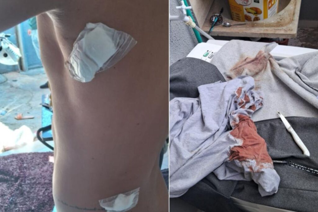 Segundo a PM, a namorada usou uma faca e feriu o tórax e as costas do companheiro (Foto: Reprodução/PM)