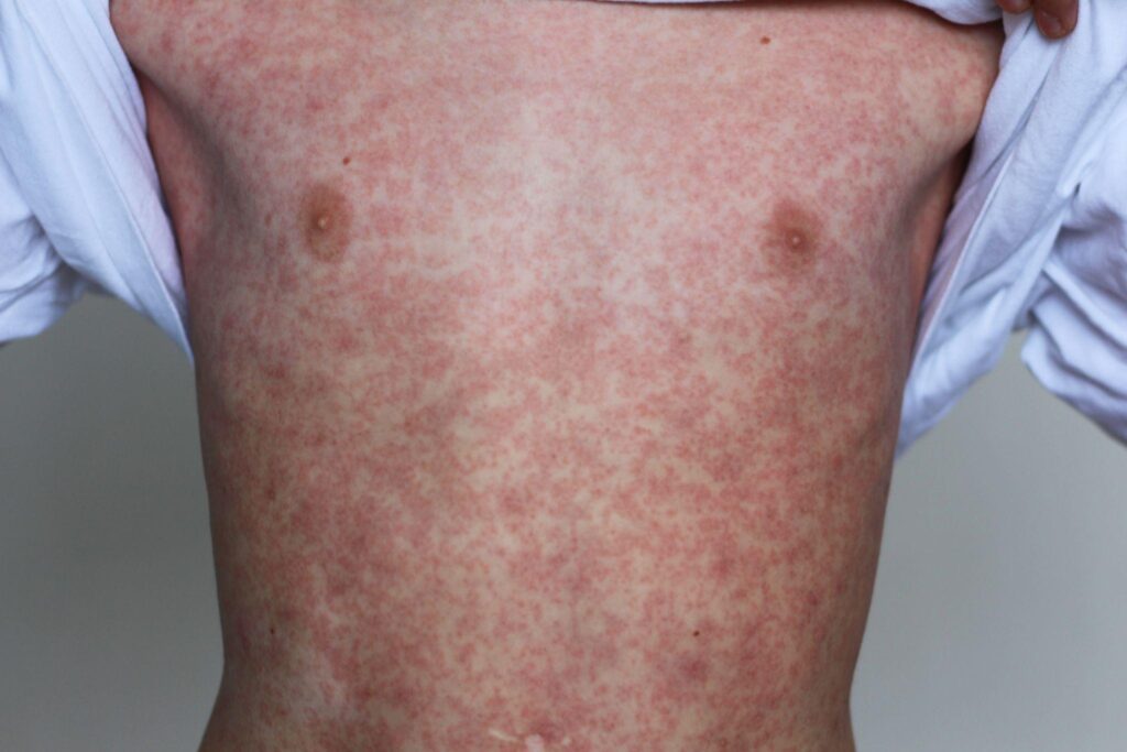 foto de pessoa com manchas avermelhadas no corpo, representando o sarampo