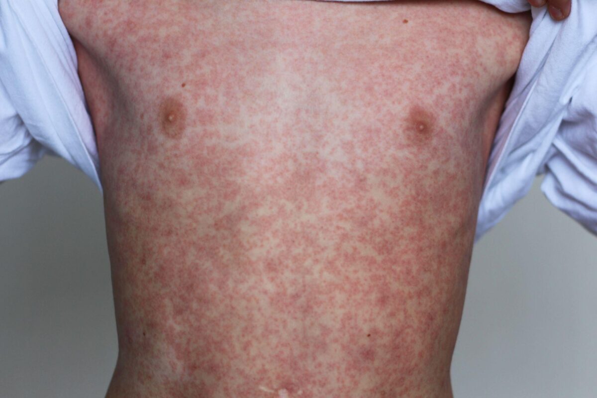 foto de pessoa com manchas avermelhadas no corpo, representando o sarampo