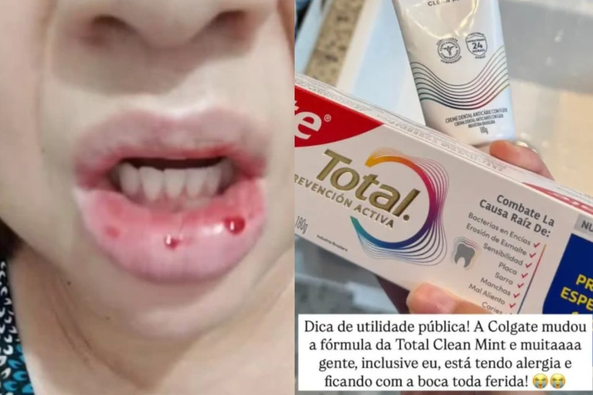 montagem com fotos da mulher que teve reação alergia após usar pasta Colgate Clean Mint