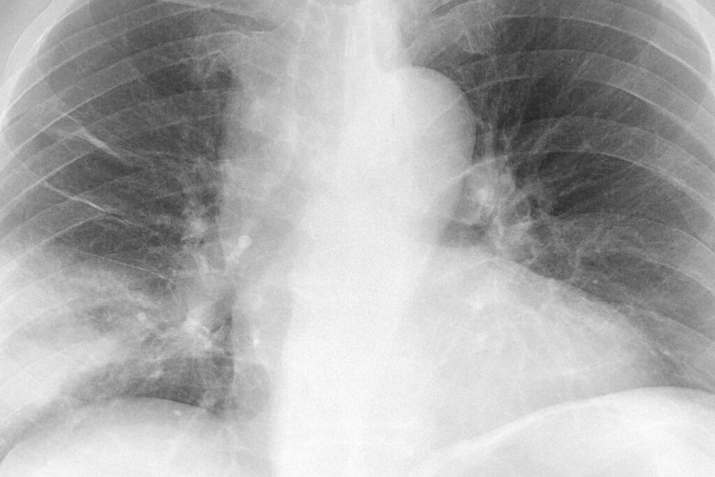 foto de raio-x de pulmão com pneumonia silenciosa
