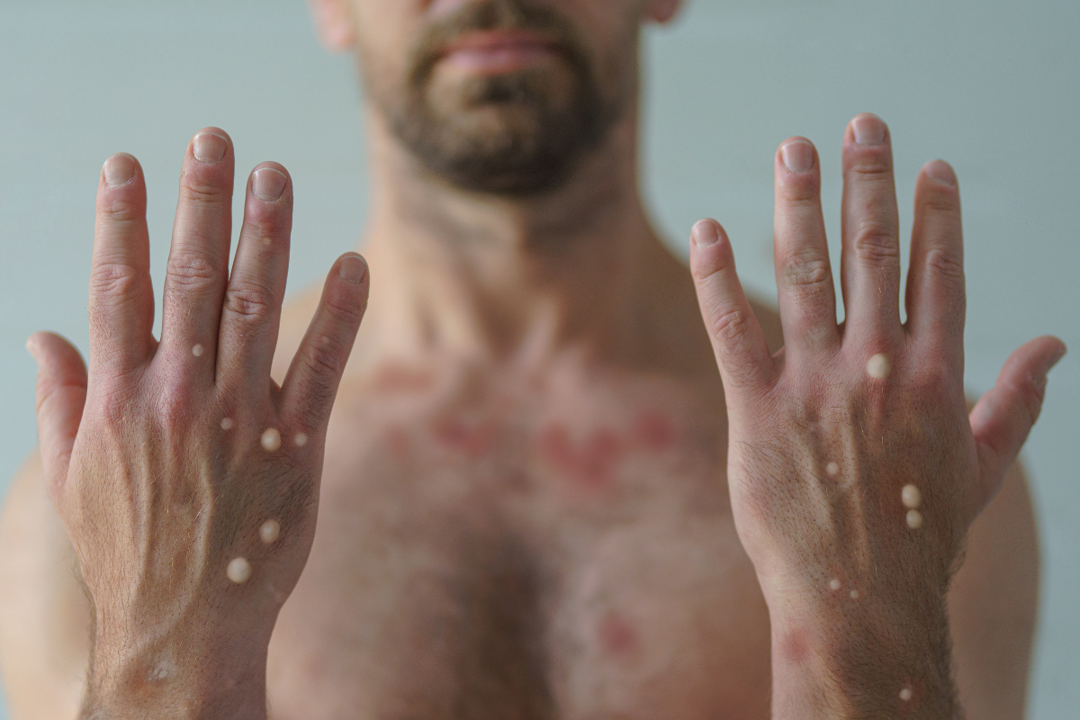 Homem com erupções na pele; um dos sintomas da Varíola dos Macacos