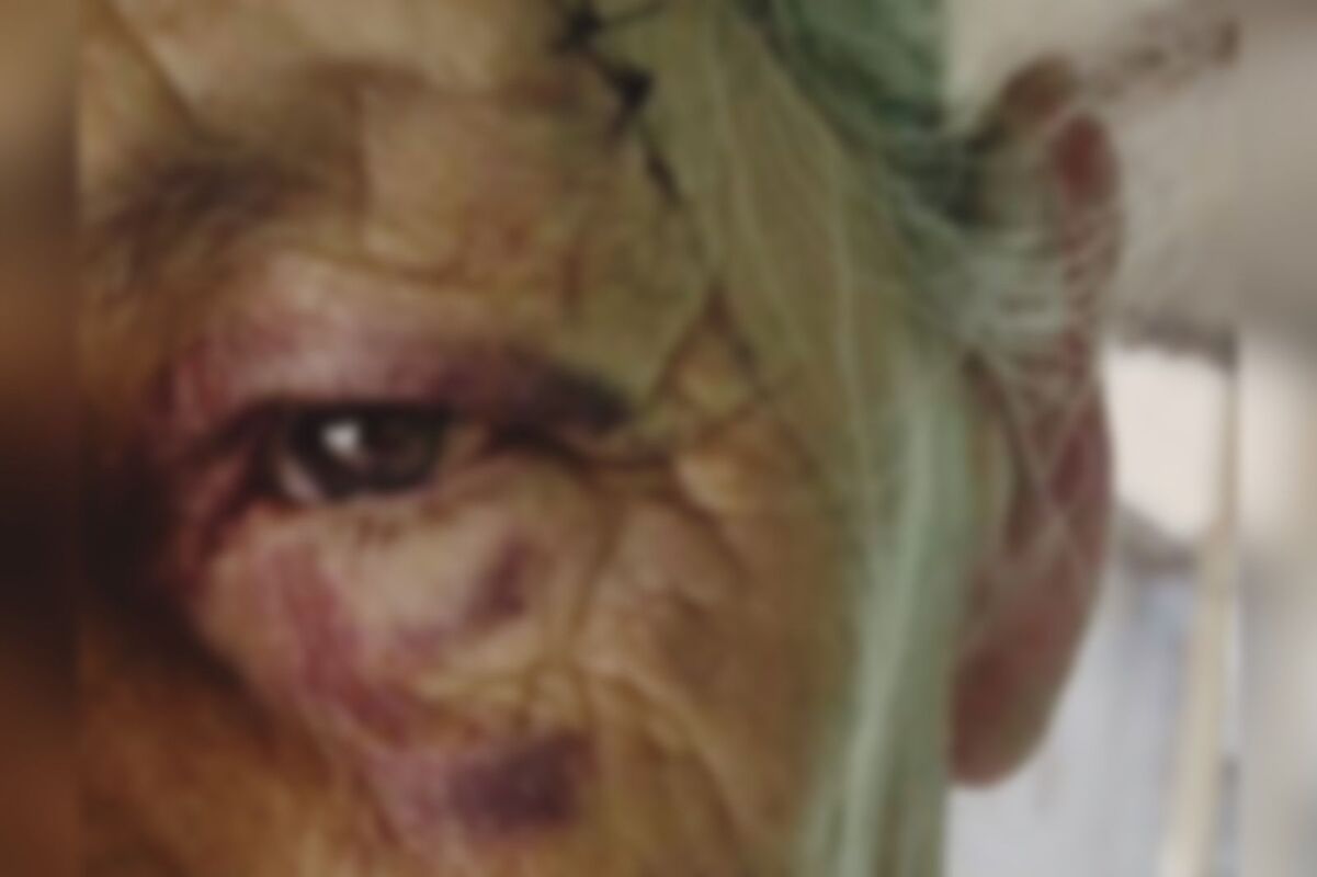 Idosa ficou com olho roxo e sofreu corte no rosto ao ser agredida pelo adolescente (Foto: Reprodução)