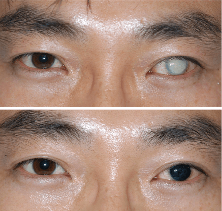 Ceratopigmentação para cobertura de um olho com cegueira (Foto: Reprodução / Hospital de Olhos Dr. Ricardo Guimarães)