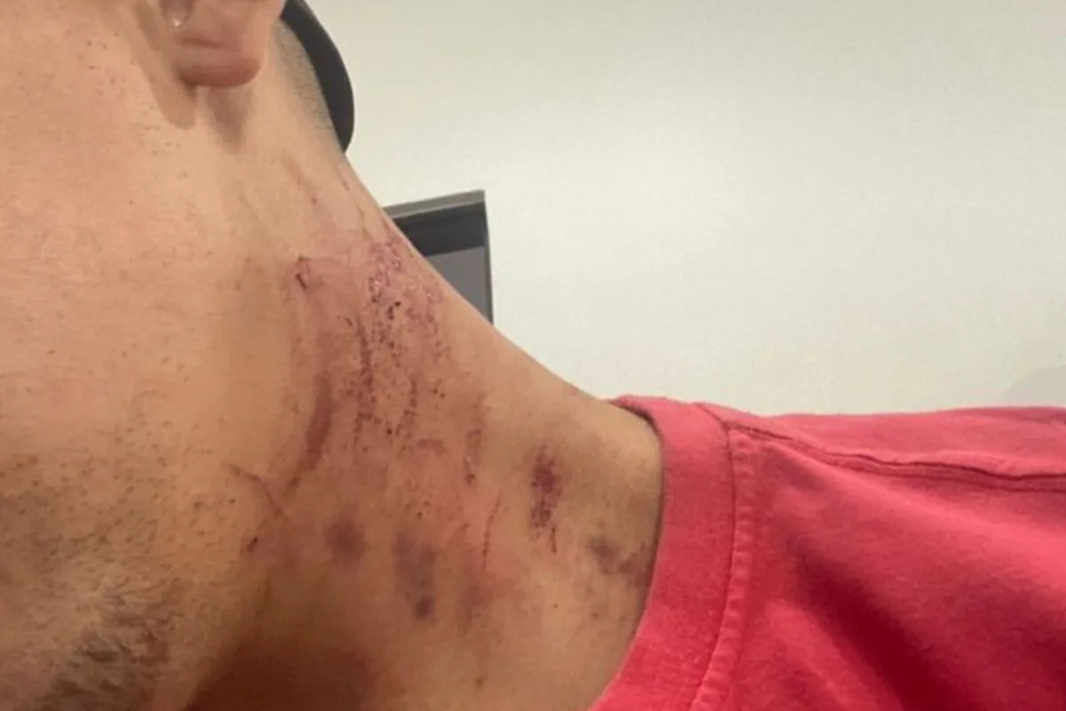 Rapaz com o pescoço arranhado ao ser agredido pela namorada (Foto: Reprodução/PM)