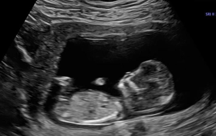 Imagem de ultrassonografia divulgada por Viih Tube em perfil de filho que ainda não nasceu