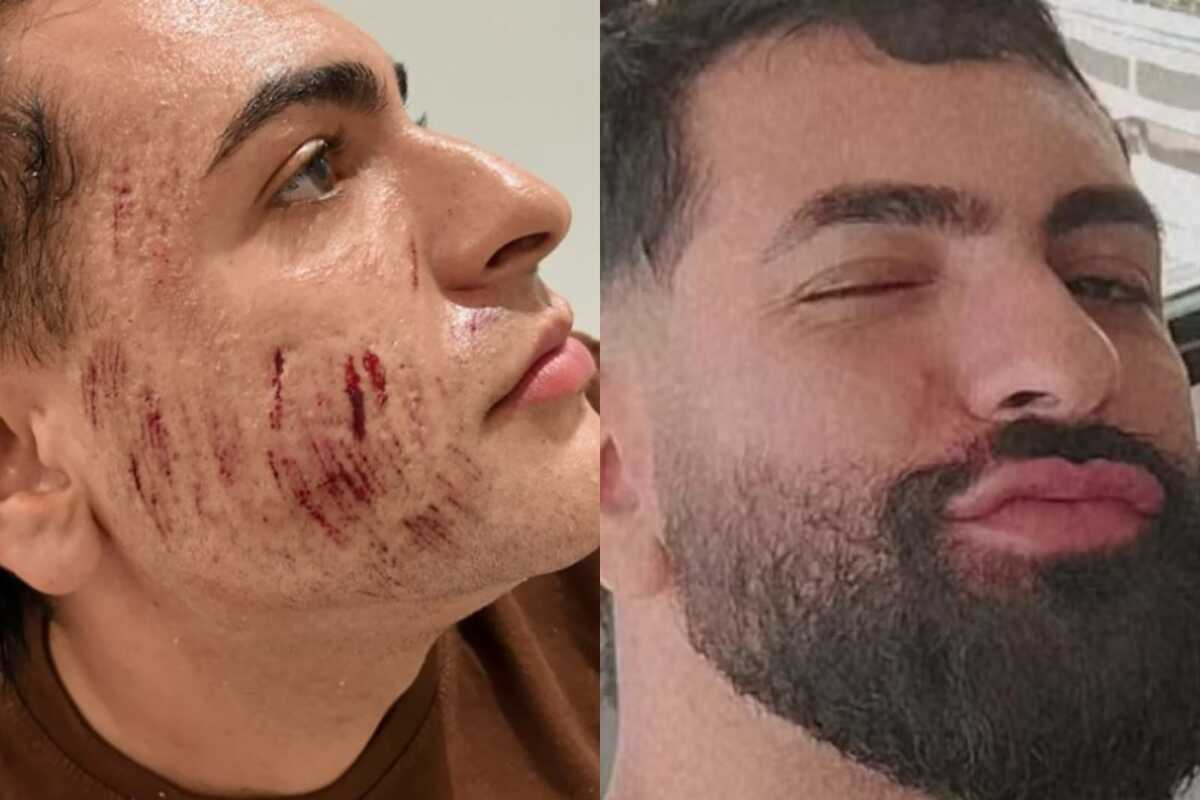Henrique foi submetido ao peeling de fenol no dia 3 de junho deste ano. (Foto: reprodução)