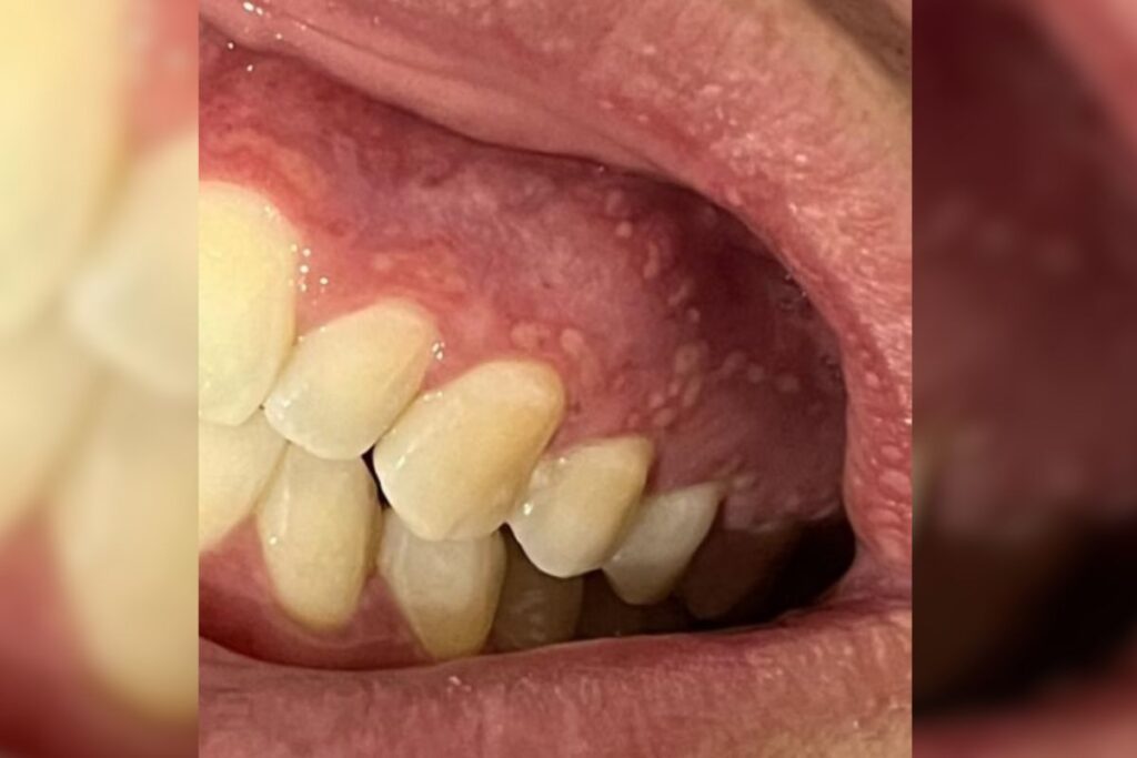 foto de gengiva acometida por alergia da pasta colgate clean mint